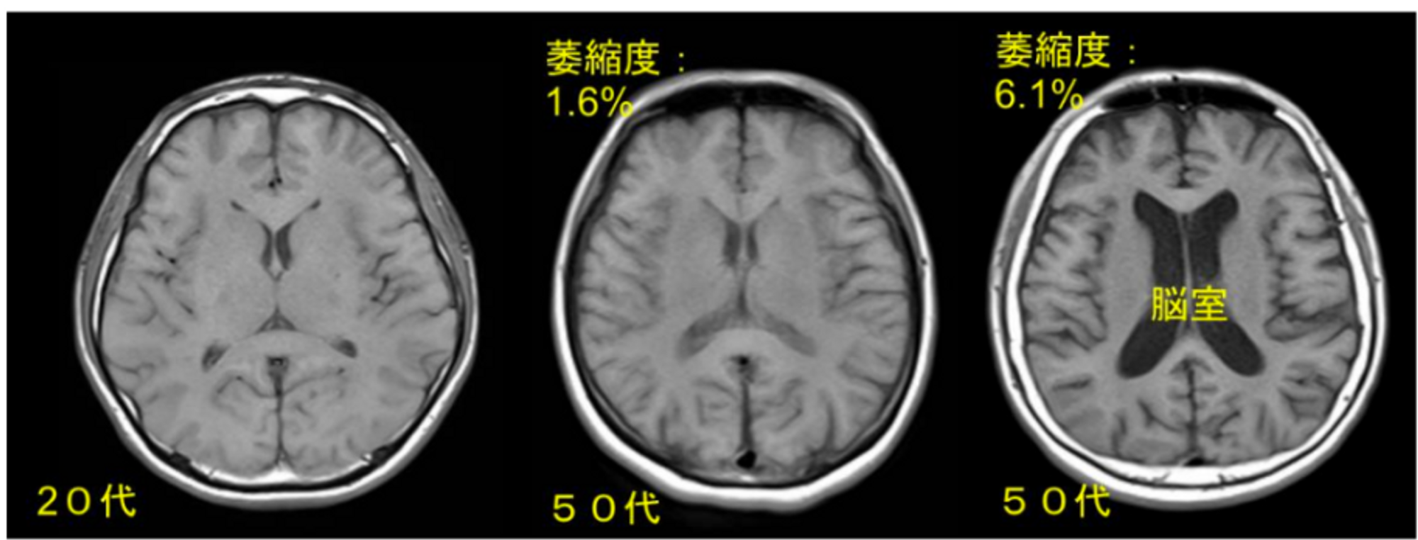 脳の加齢性変化の度合いの個人差.png